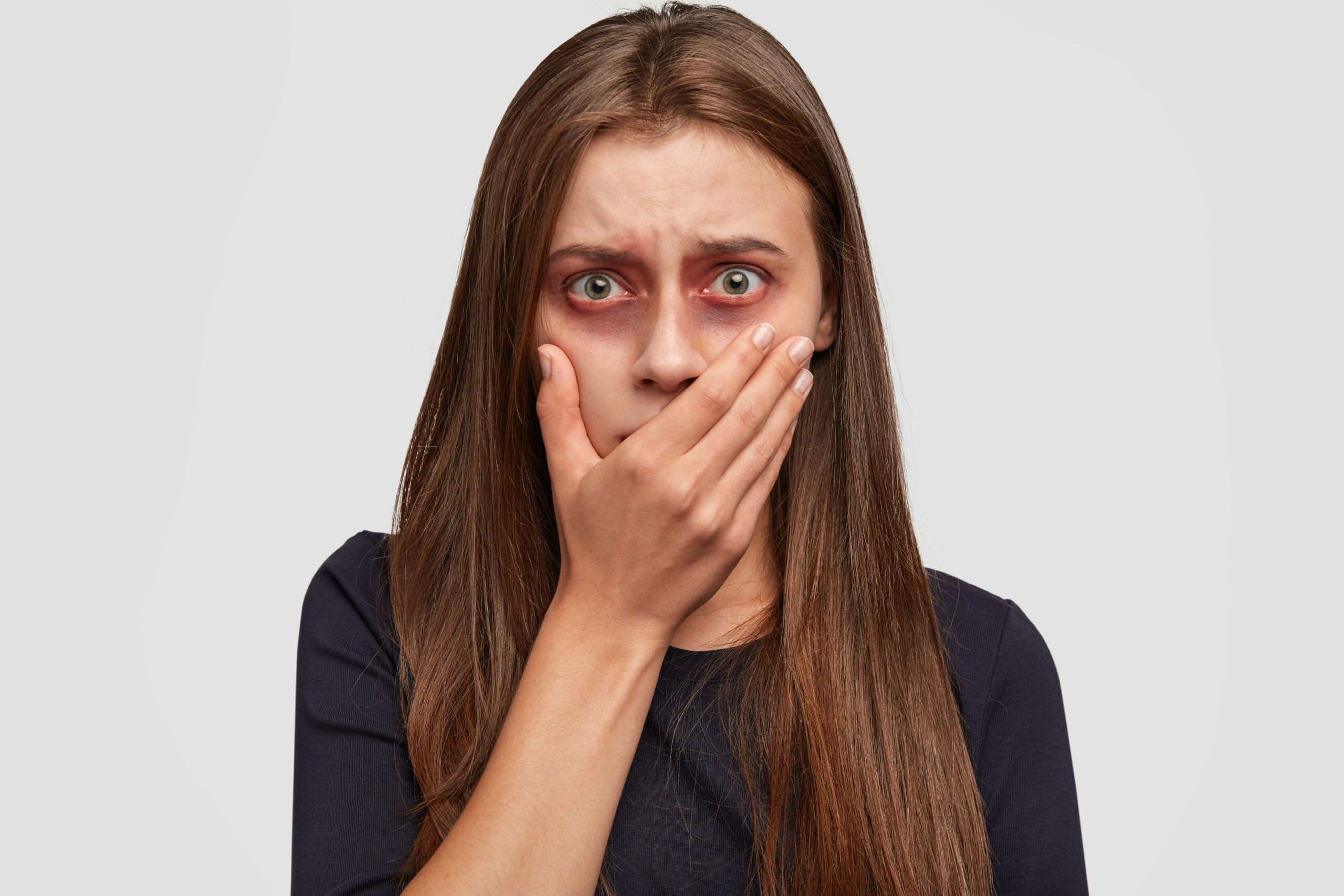 Human trafficking, abuse and hopelessness concept. Beaten up girl covers mouth, stares with eyes full of fear, has bruised skin, suffers from domestic violence, needs help, intimidated by husband